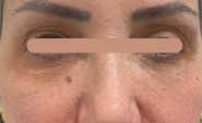 Preenchimento da região infraorbital (olheiras) — Feminino: registro depois do procedimento